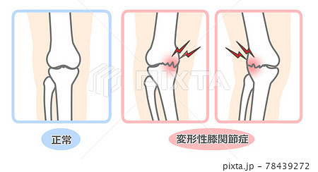 変形性膝関節症 図解のイラスト素材
