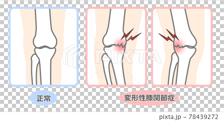 変形性膝関節症　図解 78439272