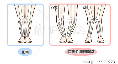変形性膝関節症　図解 78439273