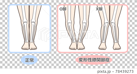変形性膝関節症　図解 78439273