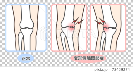 膝關節骨關節炎圖示 78439274