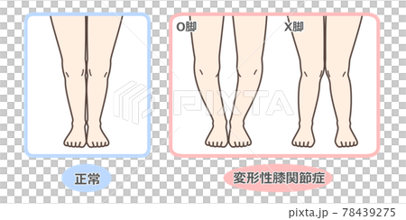 膝關節骨關節炎圖示 78439275