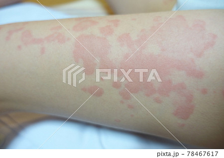 じんましん 蕁麻疹 湿疹 じんましん 蕁麻疹 湿疹 78467617
