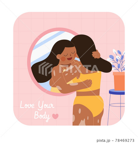 Woman with vitiligo hugging herself 78469273
