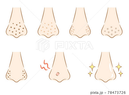 鼻の毛穴の汚れのイラスト おしゃれタッチ 鼻の毛穴の汚れのイラスト おしゃれタッチ 78473726