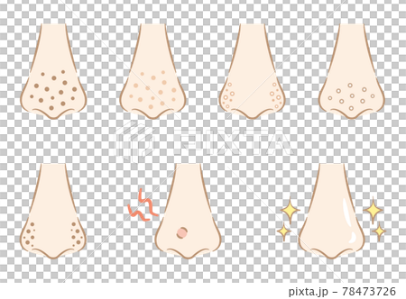 Illustration of dirt on the pores of the nose Fashionable touch 78473726