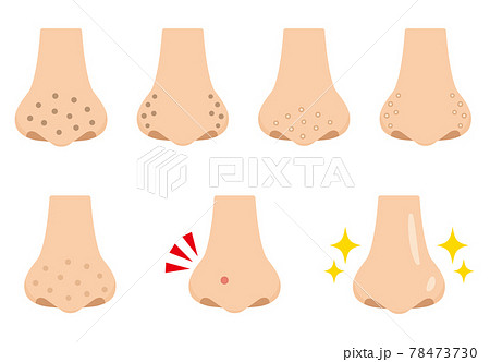 鼻の毛穴の汚れのイラスト フラットデザイン 鼻の毛穴の汚れのイラスト フラットデザイン 78473730