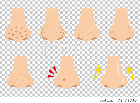 鼻の毛穴の汚れのイラスト フラットデザイン 鼻の毛穴の汚れのイラスト フラットデザイン 78473730