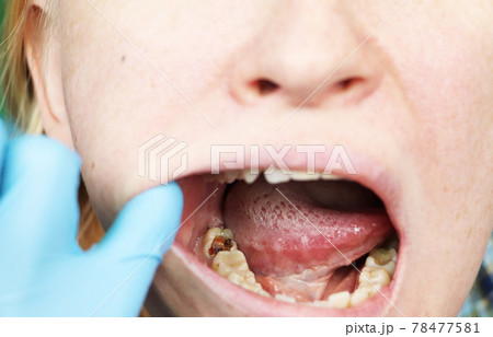 Deep caries, open canals, cleaning canals. Patient at stomatolon on admission, periodontitis treatment Deep caries, open canals, cleaning canals. Patient at stomatolon on admission, periodontitis treatment 78477581