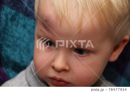 A big bruise on the forehead of a little boy A big bruise on the forehead of a little boy 78477934