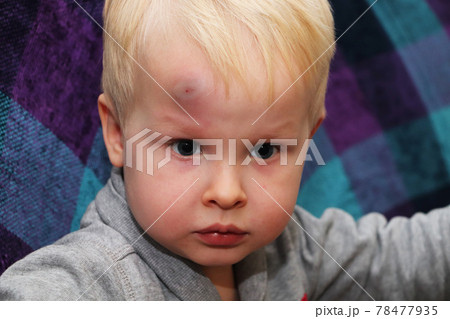 A big bruise on the forehead of a little boy A big bruise on the forehead of a little boy 78477935