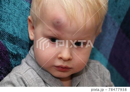A big bruise on the forehead of a little boy 78477938