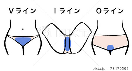 VIO、デリケートゾーン脱毛部位 78479595