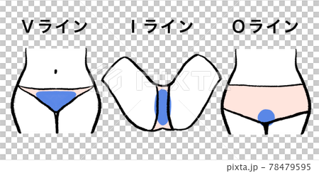 VIO、デリケートゾーン脱毛部位 78479595
