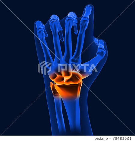 3D_Illustration_wrist_painful_human_skeleton_medical_concept 78483631
