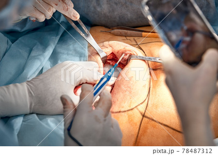 Mammoplasty, reconstruction of female mammary glands, after cancer, installation of an expander, close-up, plastic surgery of a female breast 78487312