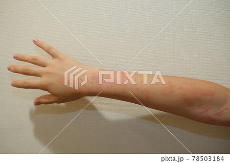 じんましん 蕁麻疹 湿疹 じんましん 蕁麻疹 湿疹 78503184