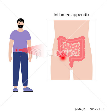 Appendix pain concept Appendix pain concept 78522103