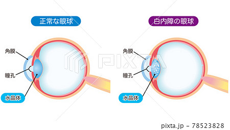 白内障の構造 断面図のイラスト素材