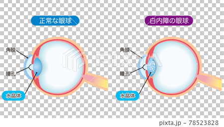 白内障の構造　断面図 78523828