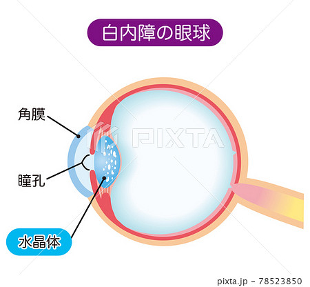 白内障の構造　断面図 78523850
