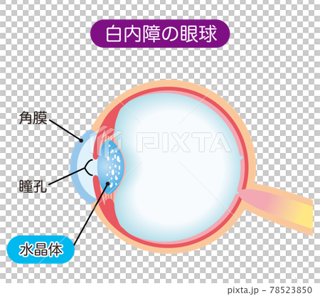 白内障の構造　断面図 78523850