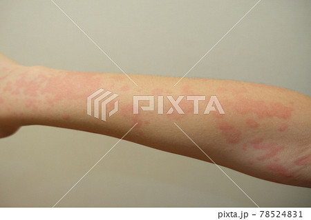 じんましん　蕁麻疹　湿疹 78524831