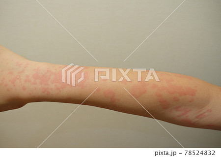 じんましん　蕁麻疹　湿疹 78524832