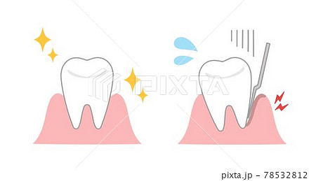 健康な歯茎と歯周病の歯茎のイラストのイラスト素材