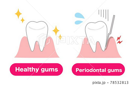 健康な歯茎と歯周病の歯茎のイラストのイラスト素材