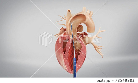Aortic prosthesis surgery attachment of artificial prosthetic aortic valve to heart in animated human model Aortic prosthesis surgery attachment of artificial prosthetic aortic valve to heart in animated human model 78549883