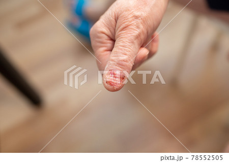 Felon whitlow on finger toe injured to lose nail Felon whitlow on finger toe injured to lose nail 78552505