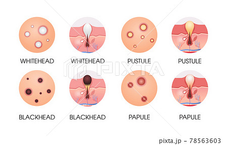 set different facial skin pimples acne types pore comedones cosmetology skincare problems concept flat horizontal 78563603