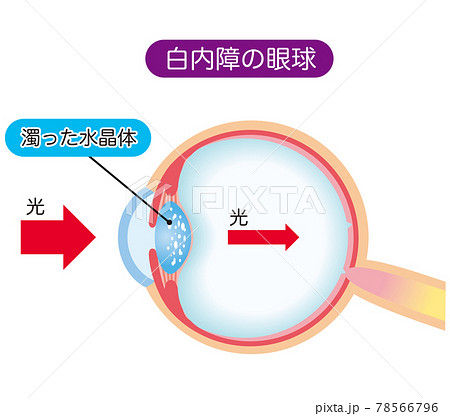 白内障の構造 断面図のイラスト素材