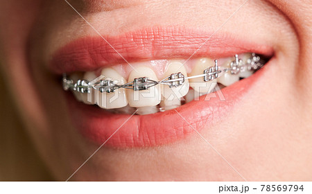 Female smile with metal braces on white teeth. Female smile with metal braces on white teeth. 78569794