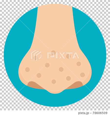 Illustration of dirty nose, freckles, strawberry nose, crater, acne scars, flat design Illustration of dirty nose, freckles, strawberry nose, crater, acne scars, flat design 78606509