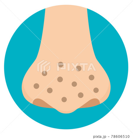 鼻の毛穴の汚れイラスト いちご鼻 フラットデザインのイラスト素材