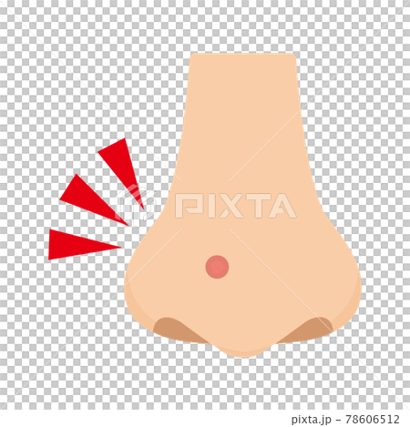 Illustration of acne on the nose Illustration of acne on the nose 78606512