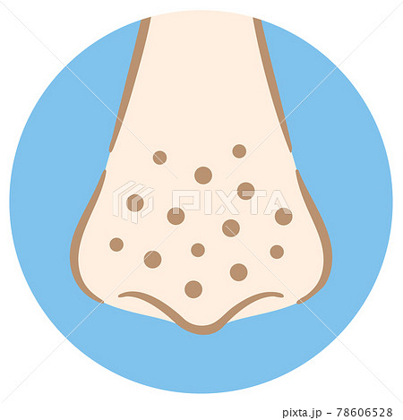 鼻の毛穴の汚れイラスト いちご鼻 手描き風のイラスト素材
