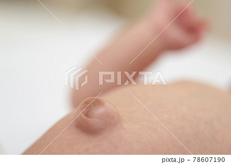 臍ヘルニアの赤ちゃんのおへそ 78607190