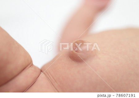 臍ヘルニアの赤ちゃんのおへそ 78607191