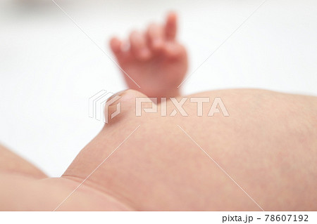 臍ヘルニアの赤ちゃんのおへそ 78607192