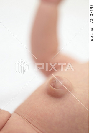 臍ヘルニアの赤ちゃんのおへそ 78607193