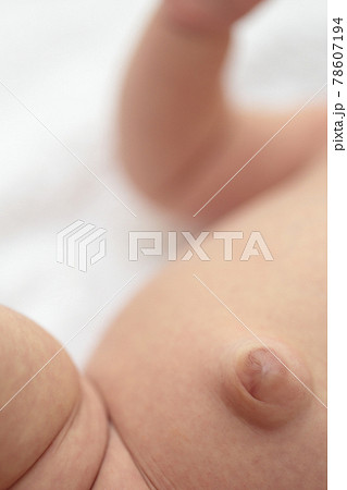 臍ヘルニアの赤ちゃんのおへそ 78607194