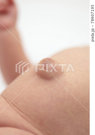 臍ヘルニアの赤ちゃんのおへそ 78607195