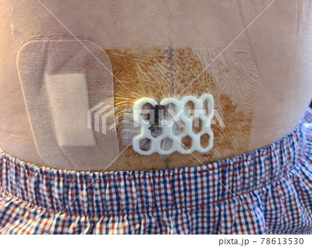 脊柱管狭窄症の手術後 78613530