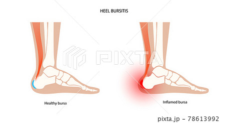 Bursitis inflammation concept 78613992