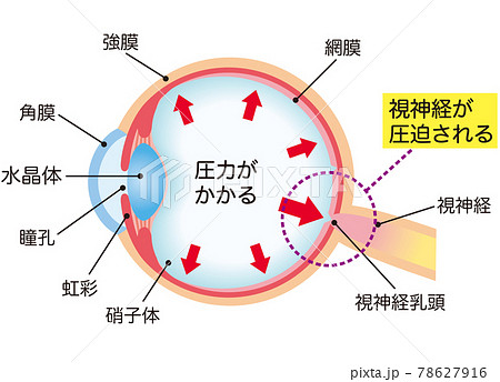 緑内障の構造　断面図 78627916