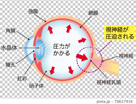 Structure of glaucoma cross section 78627916