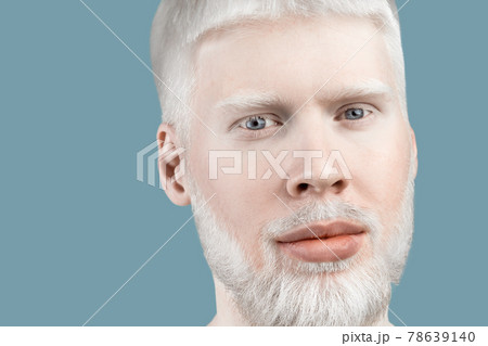 Albinism concept. Portrait of young bearded albino man with white hair, pale skin and blue eyes, turquoise background 78639140